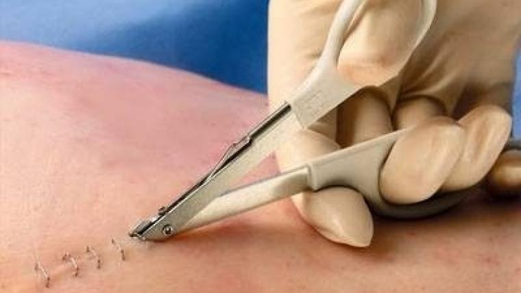 Hechtingen En Agrafen Verwijderen E Nursing
